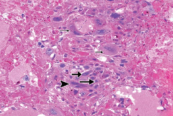 Choriocarcinoma